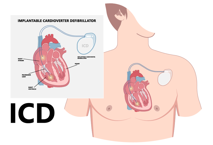 Pacemaker: Surgery, Types & What It Is